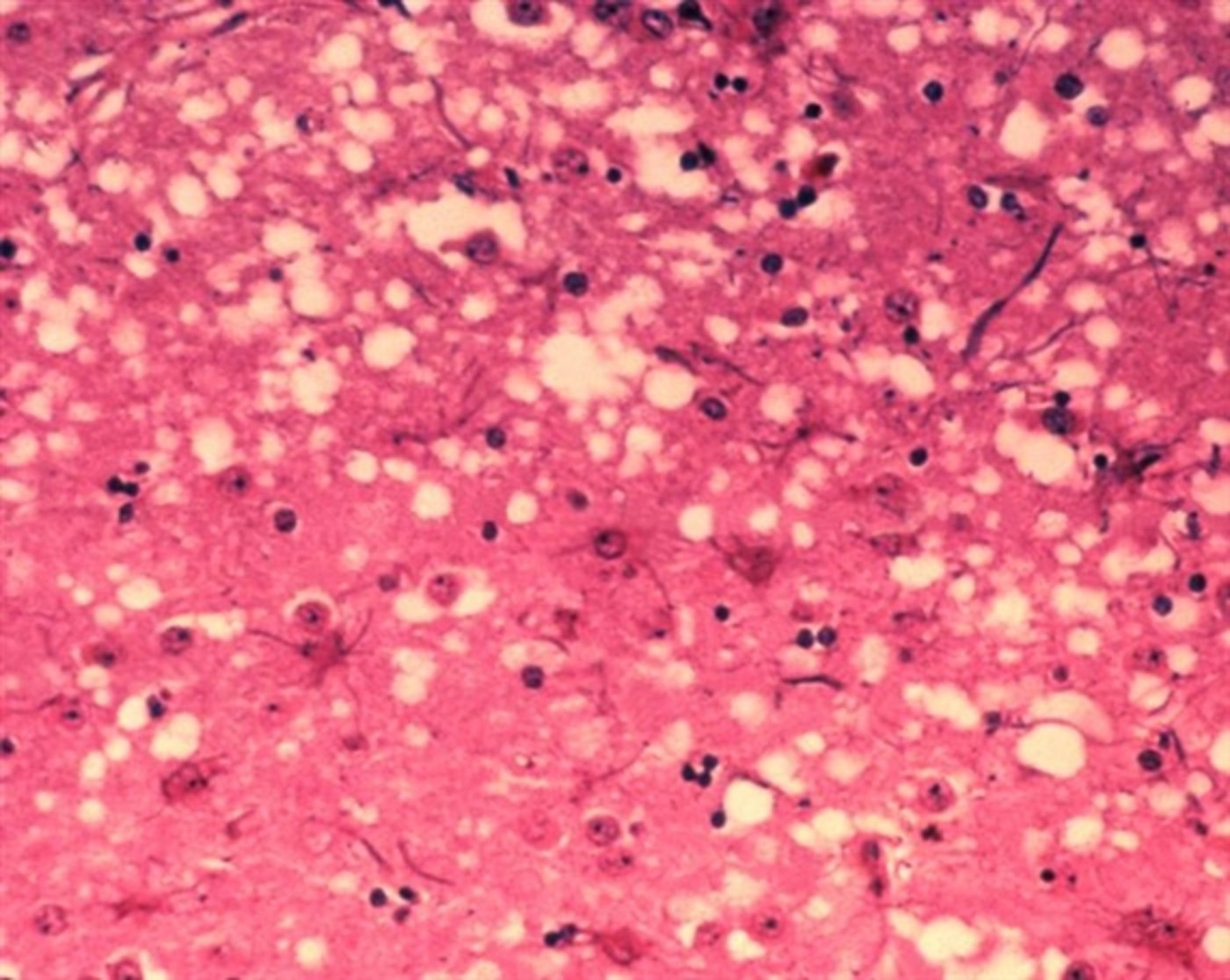  Das Bild zeigt die histopathologischen Veränderungen, die bei einer Infektion mit BSE auftreten. (Bild Dr. Al Jenny) 