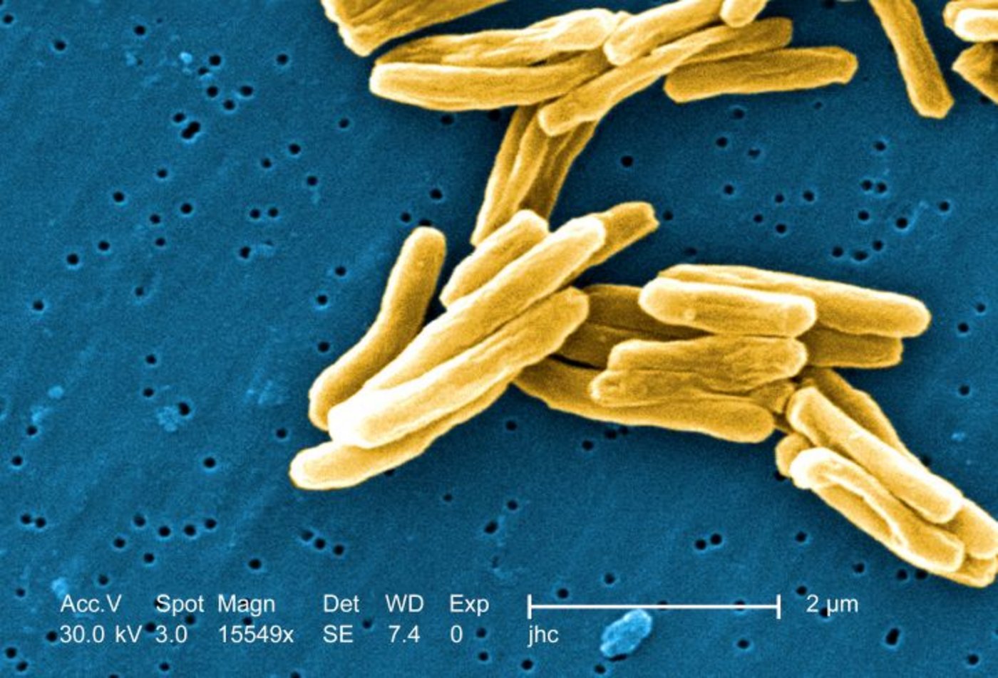Bei der Tuberkulose handelt es sich um eine Infektionserkrankung, die durch verschiedene Mykobakterien hervorgerufen wird. (Bild pixinio)